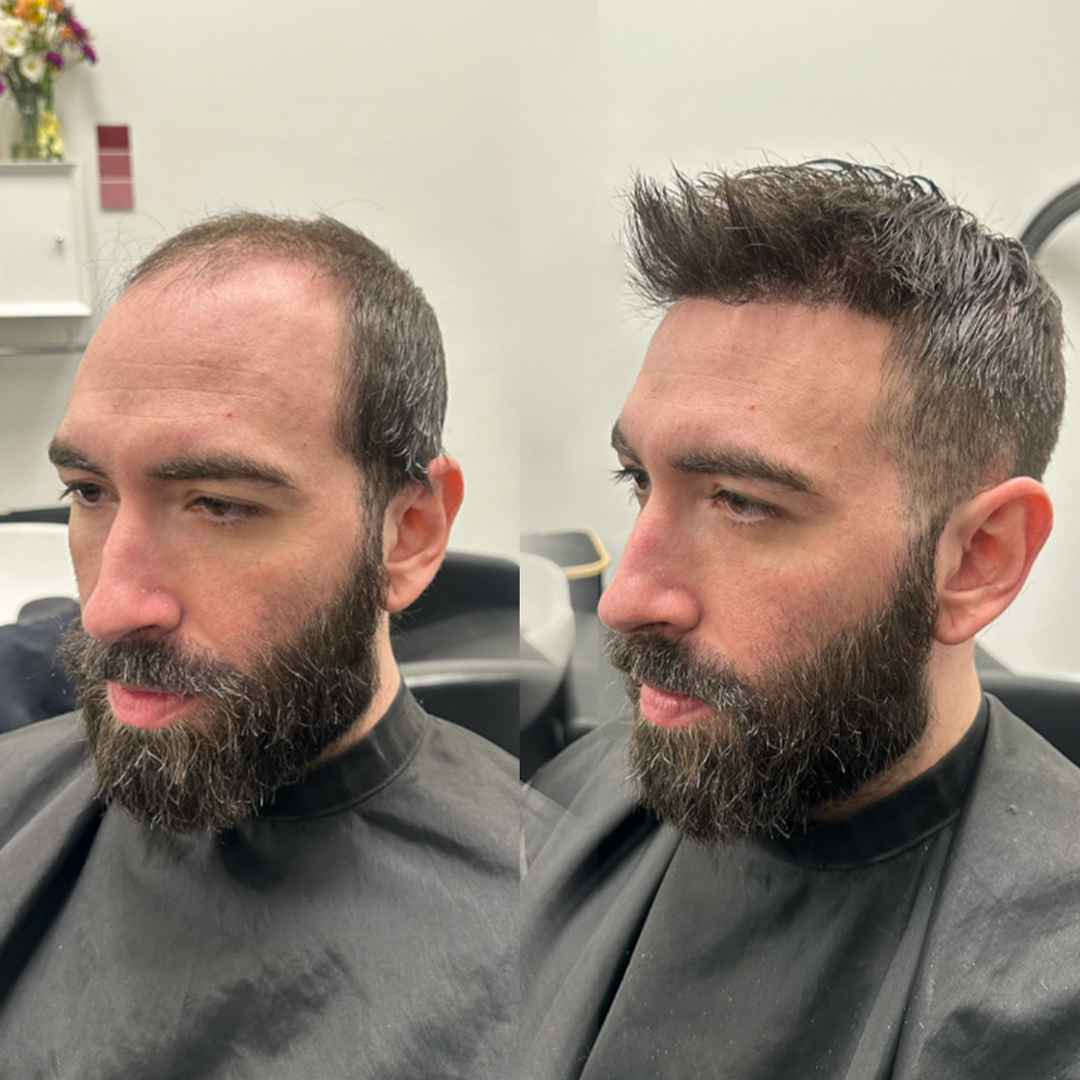 Before and after hair system transformation