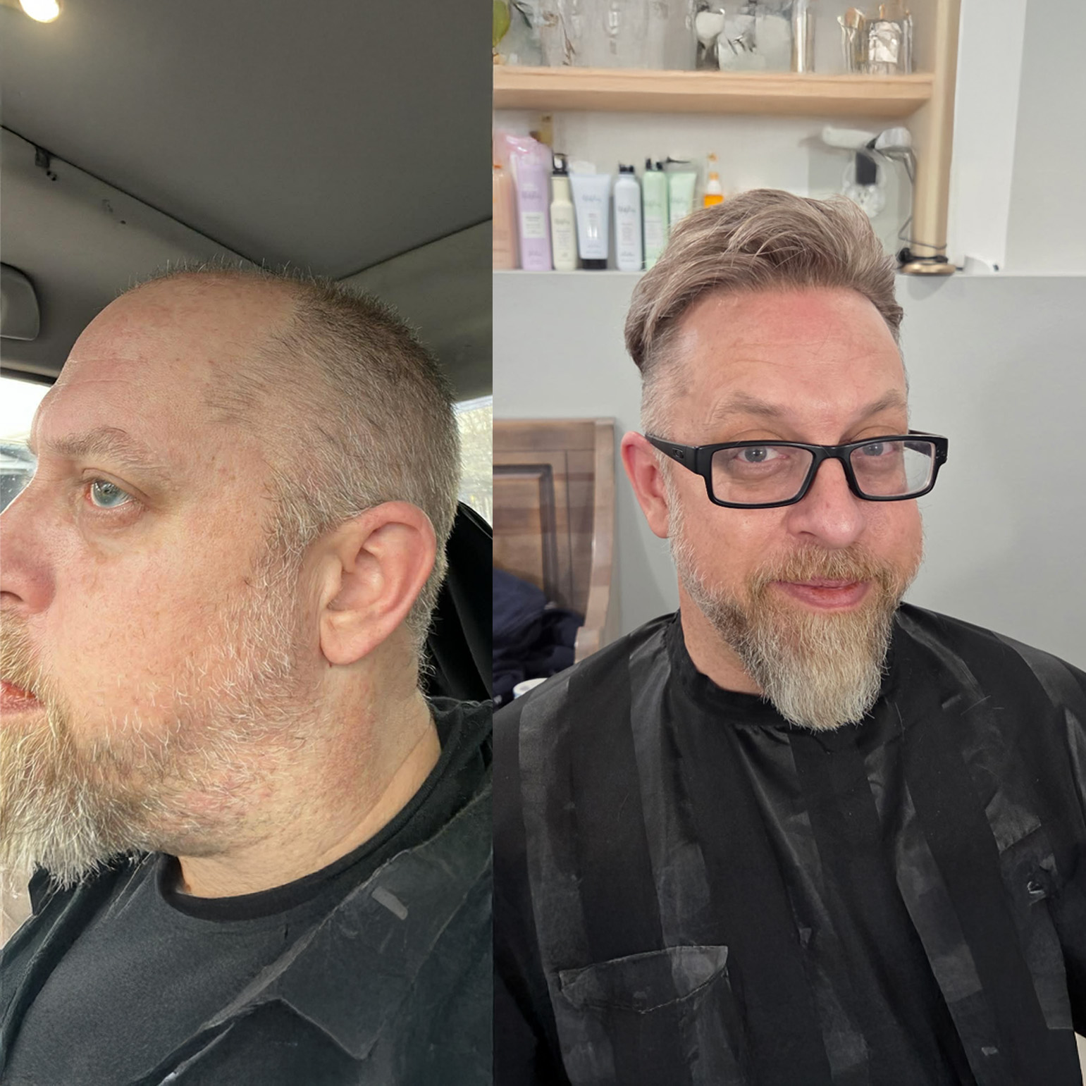 Before and after hair system transformation